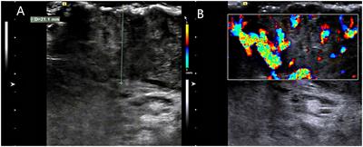 Case report: A case of giant breast skin warts caused by HPV infection